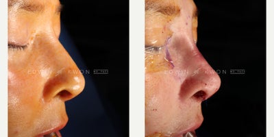 Revision Rhinoplasty before and after photo