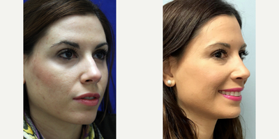 Rhinoplasty before and after photo