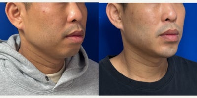 Chin Implant before and after photo