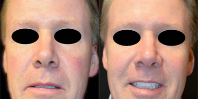 Laser Resurfacing before and after photo