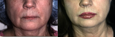 Lip Lift before and after photo
