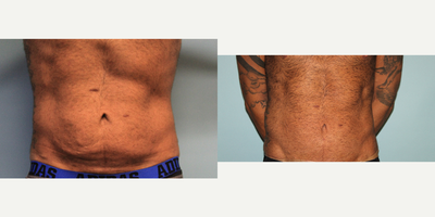 Tummy Tuck before and after photo