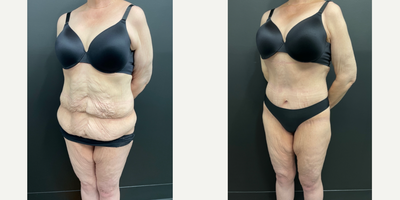 Body Lift before and after photo
