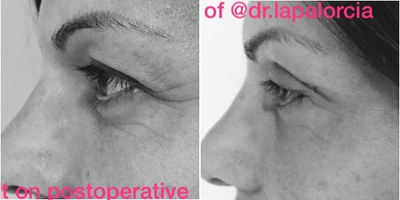 Eyelid Surgery before and after photo