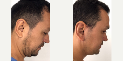 Facelift before and after photo
