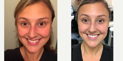 Laser Peel before and after photo