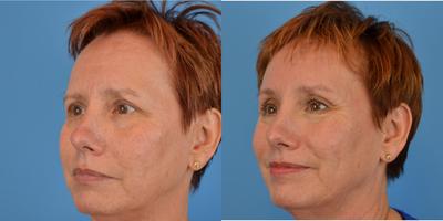 Brow Lift before and after photo