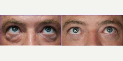 Eyelid Surgery before and after photo