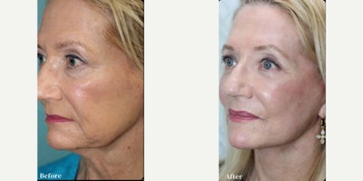 Facelift before and after photo