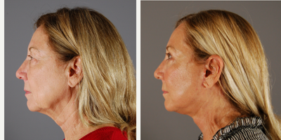 MACS Facelift before and after photo