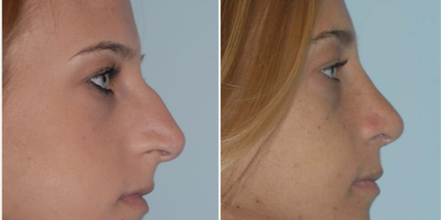 Rhinoplasty before and after photo
