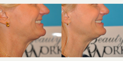 Rhinoplasty before and after photo