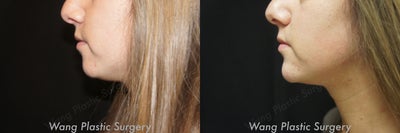 Chin Filler before and after photo