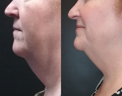 CoolSculpting before and after photo