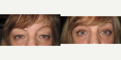 Double Eyelid Surgery before and after photo