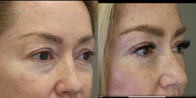 Eyelid Surgery before and after photo