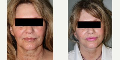 Facelift before and after photo