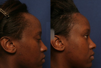 Forehead Reduction before and after photo