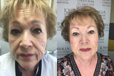 Liquid Facelift before and after photo