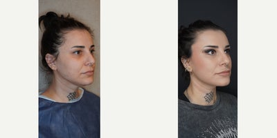 Neck Lift before and after photo