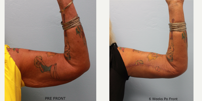 Arm Lift before and after photo