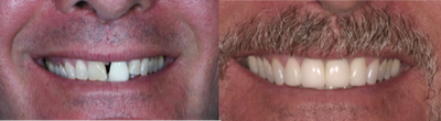 Dental Crown before and after photo