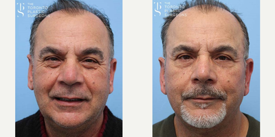 Eyelid Surgery before and after photo