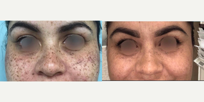 Laser Resurfacing before and after photo