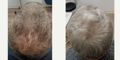 PRP for Hair Loss before and after photo