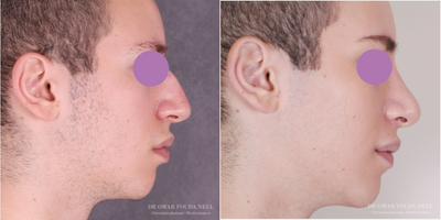 Rhinoplasty before and after photo