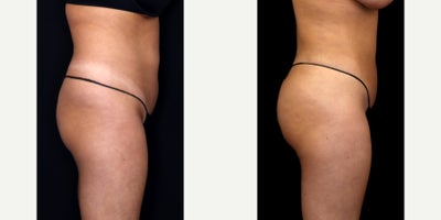 Brazilian Butt Lift before and after photo