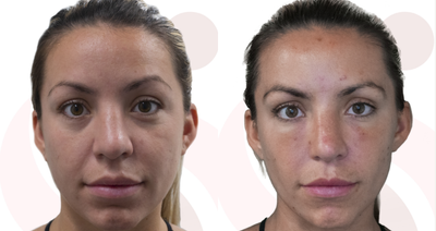 Dermal Fillers before and after photo