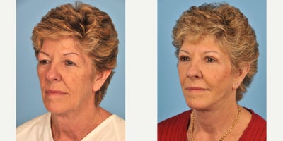 Facelift before and after photo