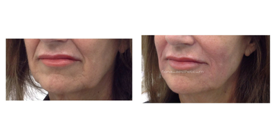 Restylane Defyne before and after photo
