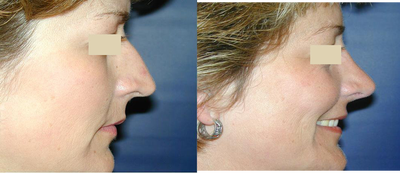 Rhinoplasty before and after photo