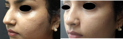Rhinoplasty before and after photo