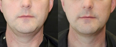 Ultherapy before and after photo