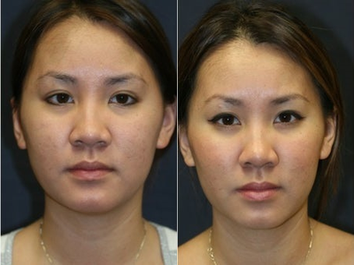 Asian Rhinoplasty before and after photo