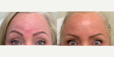 Botox before and after photo