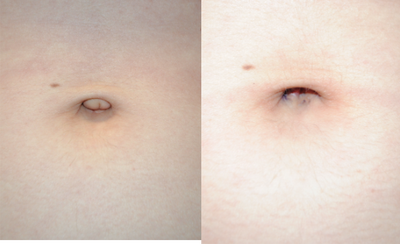 Belly Button Surgery before and after photo