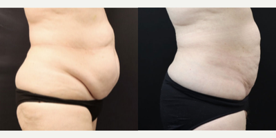 BodyTite before and after photo