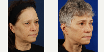 Facelift before and after photo