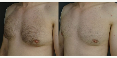 Gynecomastia Surgery before and after photo