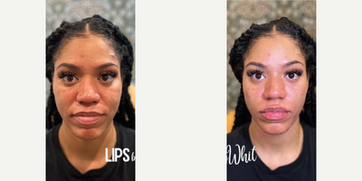 Lip Fillers before and after photo