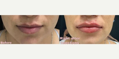 Restylane Lyft before and after photo