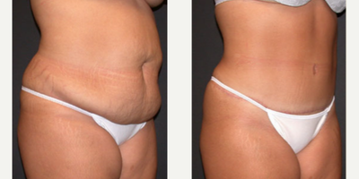 Tummy Tuck before and after photo