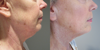 Ultherapy before and after photo