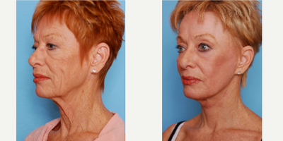 Neck Lift before and after photo