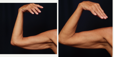 Thermage before and after photo