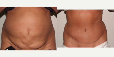Tummy Tuck before and after photo